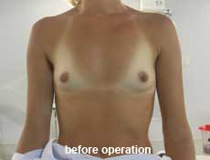 plastic-surgery-breast-augmentation 